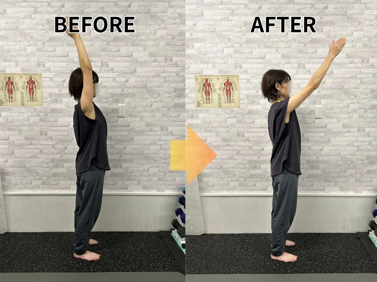 姿勢改善ビフォーアフター｜猫背改善・胸が開く変化